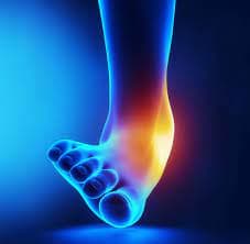 Ankle sprain